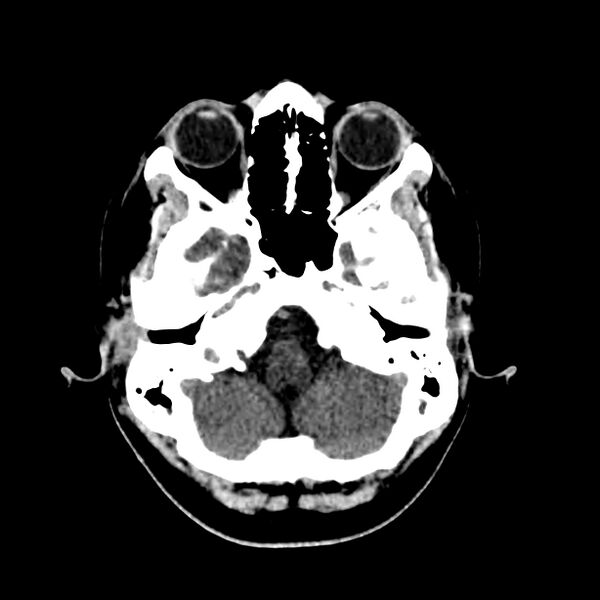 File:Central nervous system Langerhans cell histiocytosis (Radiopaedia 65728-74878 Axial non-contrast 12).jpg