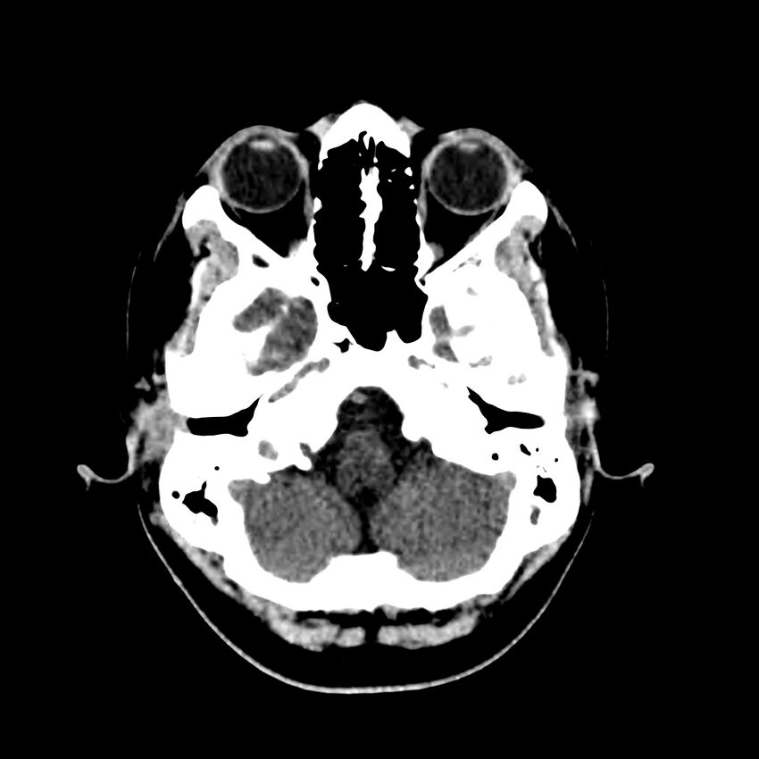 Central nervous system Langerhans cell histiocytosis (Radiopaedia 65728-74878 Axial non-contrast 12).jpg