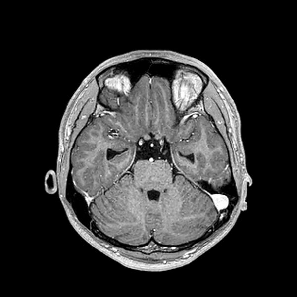 File:Central neurocytoma (Radiopaedia 79320-92380 Axial T1 C+ 91).jpg