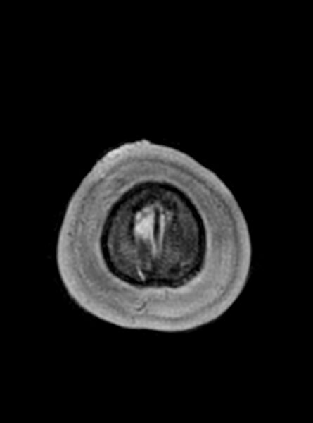 File:Central neurocytoma (Radiopaedia 79320-92381 Axial T1 44).jpg