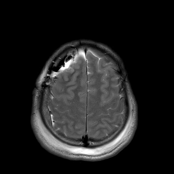 File:Central neurocytoma (Radiopaedia 79320-92381 Axial T2 22).jpg
