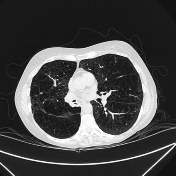File:Centrilobular pulmonary emphysema (Radiopaedia 24495-24789 Axial lung window 50).jpg