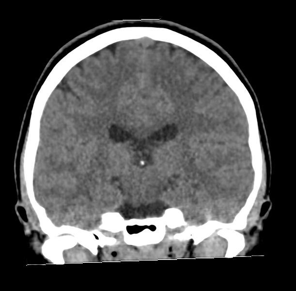 File:Cerebellar agenesis (Radiopaedia 30203-30817 Coronal non-contrast 22).jpg