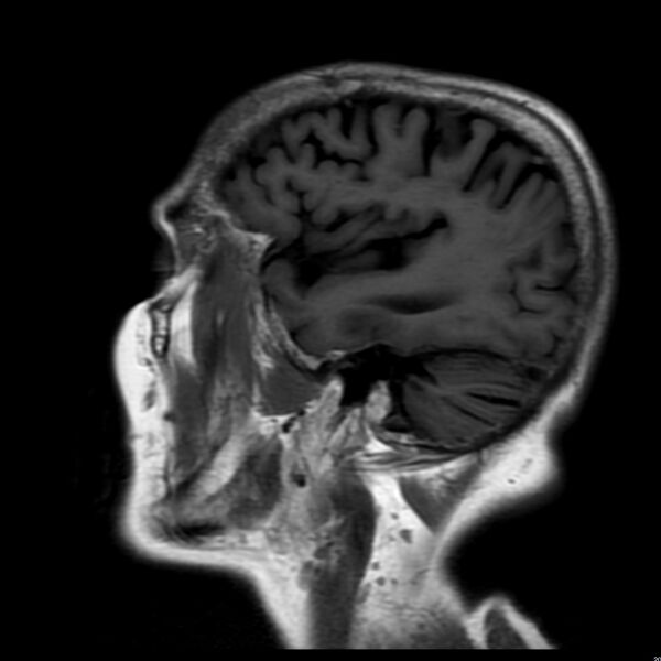 File:Cerebellar ataxia with neuropathy and vestibular areflexia syndrome (CANVAS) (Radiopaedia 74283-85159 Sagittal FLAIR 5).jpg