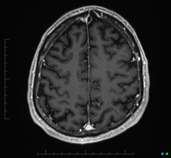File:Cerebellar gangliocytoma (Radiopaedia 65377-74422 Axial T1 C+ 109).jpg