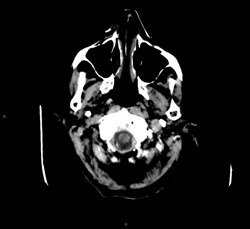 Cerebellar hemorrhage (Radiopaedia 58792-66026 Axial non-contrast 48).jpg