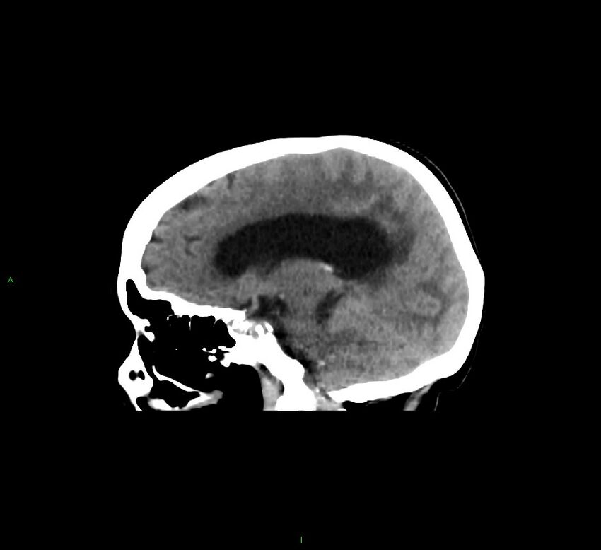 Cerebellar hemorrhage (Radiopaedia 58793-66027 C 31).jpg
