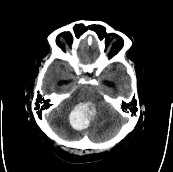 File:Cerebellar hemorrhage causing obstructive hydrocephalus (Radiopaedia 33989-35207 Axial non-contrast 14).jpg