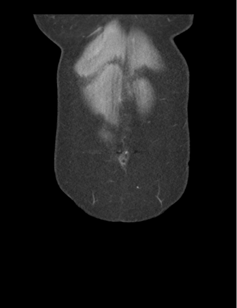 File:Cerebral abscess from pulmonary arteriovenous malformation (Radiopaedia 86275-102292 D 8).png
