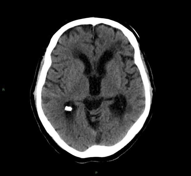 File:Cerebral amyloid angiopathy-associated lobar intracerebral hemorrhage (Radiopaedia 58376-65513 Axial non-contrast 29).jpg