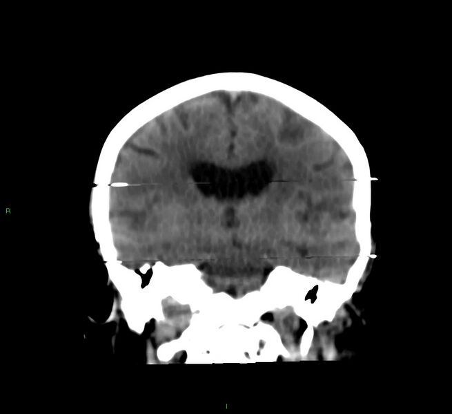 File:Cerebral amyloid angiopathy-associated lobar intracerebral hemorrhage (Radiopaedia 58377-65514 Coronal non-contrast 33).jpg