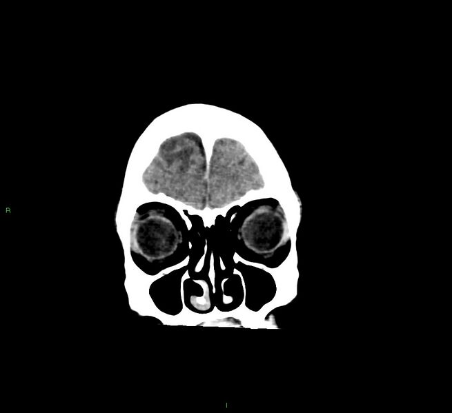 File:Cerebral amyloid angiopathy-associated lobar intracerebral hemorrhage (Radiopaedia 58529-65681 Coronal non-contrast 57).jpg