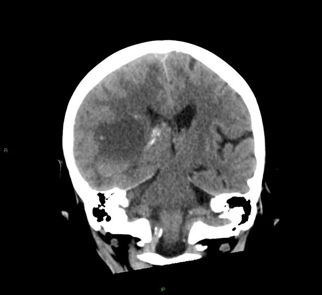 File:Cerebral amyloid angiopathy-associated lobar intracerebral hemorrhage (Radiopaedia 58563-65727 Coronal non-contrast 31).jpg