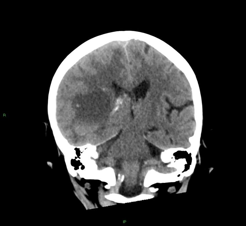 Cerebral amyloid angiopathy-associated lobar intracerebral hemorrhage (Radiopaedia 58563-65727 Coronal non-contrast 31).jpg