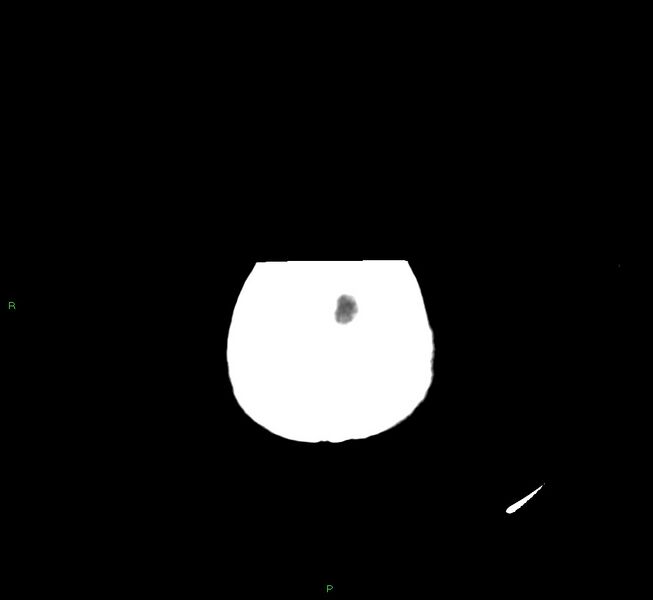 File:Cerebral amyloid angiopathy-associated lobar intracerebral hemorrhage (Radiopaedia 58751-65972 Axial non-contrast 3).jpg