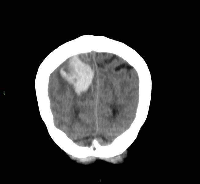 File:Cerebral amyloid angiopathy-associated lobar intracerebral hemorrhage (Radiopaedia 58751-65972 Coronal non-contrast 11).jpg