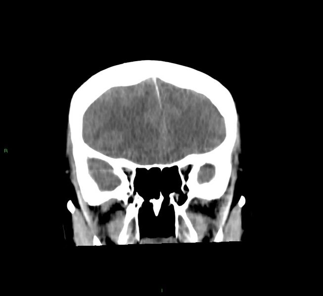 File:Cerebral amyloid angiopathy-associated lobar intracerebral hemorrhage (Radiopaedia 58756-65977 Coronal non-contrast 47).jpg