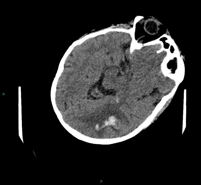File:Cerebral amyloid angiopathy-associated lobar intracerebral hemorrhage (Radiopaedia 58757-65979 Axial non-contrast 41).jpg
