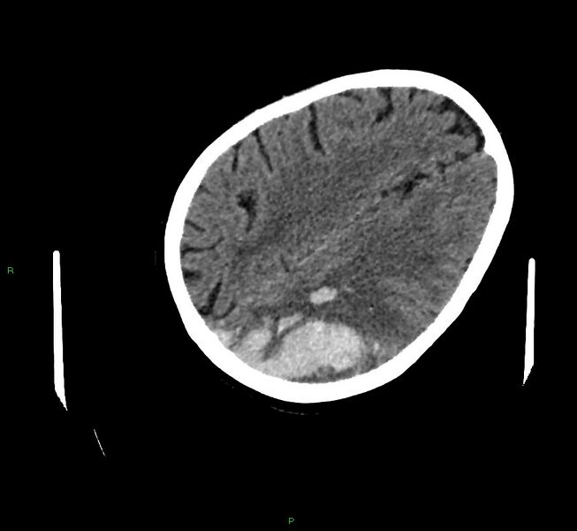 File:Cerebral amyloid angiopathy-associated lobar intracerebral hemorrhage (Radiopaedia 58757-65979 Axial non-contrast 94).jpg