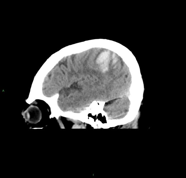 File:Cerebral amyloid angiopathy-associated lobar intracerebral hemorrhage (Radiopaedia 59356-66716 C 14).jpg