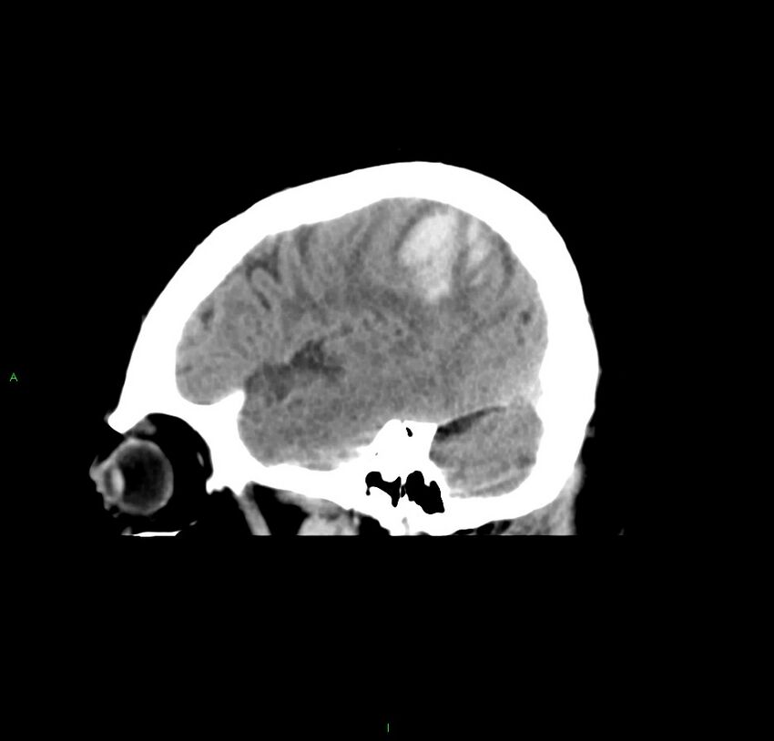 Cerebral amyloid angiopathy-associated lobar intracerebral hemorrhage (Radiopaedia 59356-66716 C 14).jpg