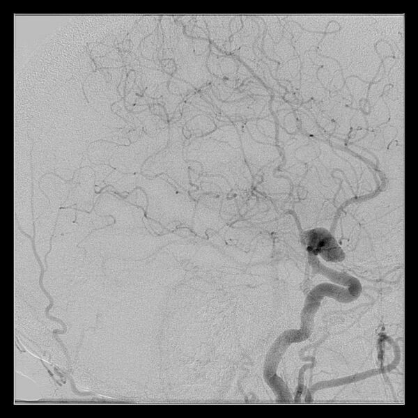 File:Cerebral aneurysm with rupture (Radiopaedia 29933-30458 LT ICA IC 43).jpg