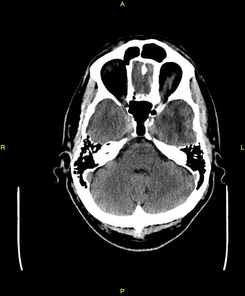 File:Cerebral autosomal dominant arteriopathy with subcortical infarcts and leukoencephalopathy (CADASIL) (Radiopaedia 86108-102051 Axial non-contrast 26).jpg