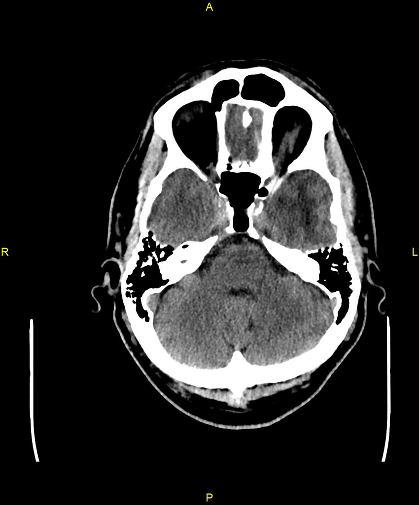 Cerebral autosomal dominant arteriopathy with subcortical infarcts and leukoencephalopathy (CADASIL) (Radiopaedia 86108-102051 Axial non-contrast 26).jpg