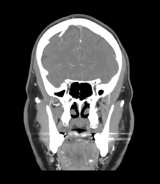 File:Cerebral dural venous sinus thrombosis (Radiopaedia 86514-102576 B 17).jpg