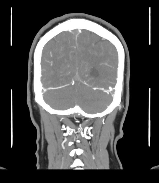 File:Cerebral dural venous sinus thrombosis (Radiopaedia 86514-102576 B 61).jpg