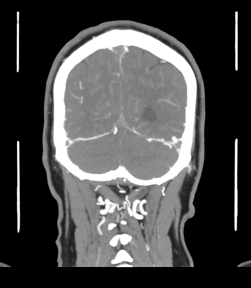 Cerebral dural venous sinus thrombosis (Radiopaedia 86514-102576 B 61).jpg