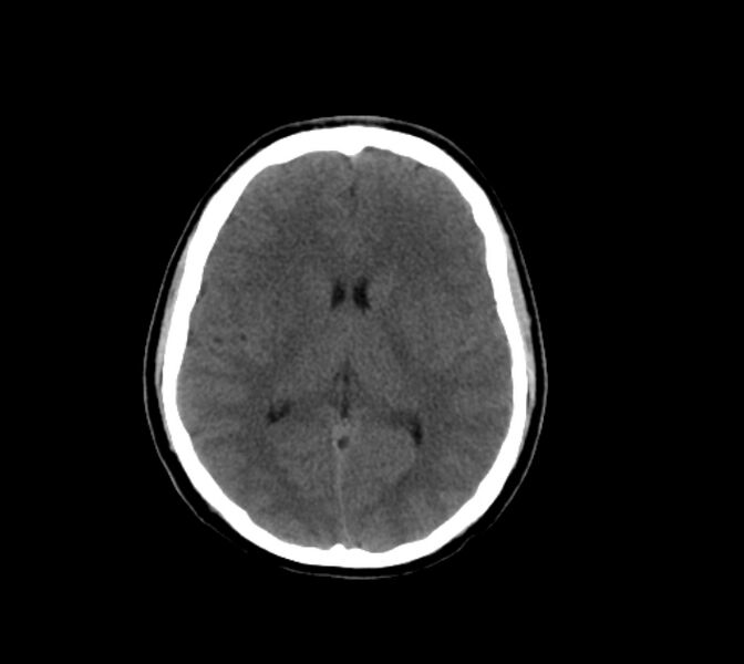 File:Cerebral fat embolism (Radiopaedia 37510-39362 Axial non-contrast 19).jpg
