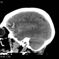 Cerebral hemorrhagic contusion with subdural and subarachnoid hemorrhage (Radiopaedia 10680-11146 C 17).jpg