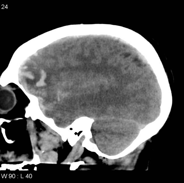 File:Cerebral hemorrhagic contusion with subdural and subarachnoid hemorrhage (Radiopaedia 10680-11146 C 17).jpg