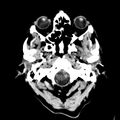 Cerebral hemorrhagic contusions (Radiopaedia 23145-23188 Axial non-contrast 1).jpg