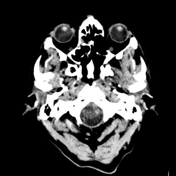 File:Cerebral hemorrhagic contusions (Radiopaedia 23145-23188 Axial non-contrast 1).jpg