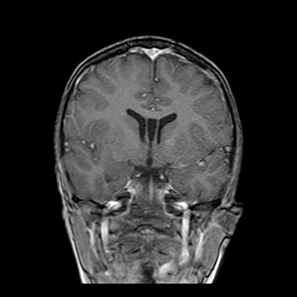 File:Cerebral tuberculoma (Radiopaedia 41152-43932 Coronal T1 C+ 8).jpg