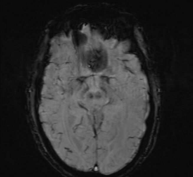 File:Cerebral venous thrombosis (Radiopaedia 71207-81504 Axial SWI 23).jpg