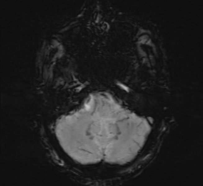 File:Cerebral venous thrombosis (Radiopaedia 71207-81504 Axial SWI 8).jpg