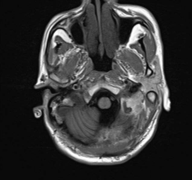 File:Cerebral venous thrombosis (Radiopaedia 71207-81504 Axial T1 4).jpg
