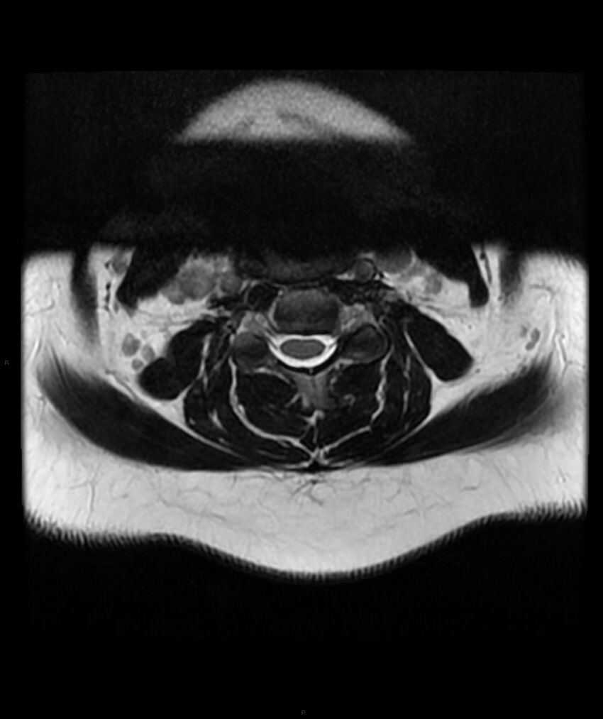 Cervical disc prolapse (Radiopaedia 80258-93598 Axial T2 23).jpg