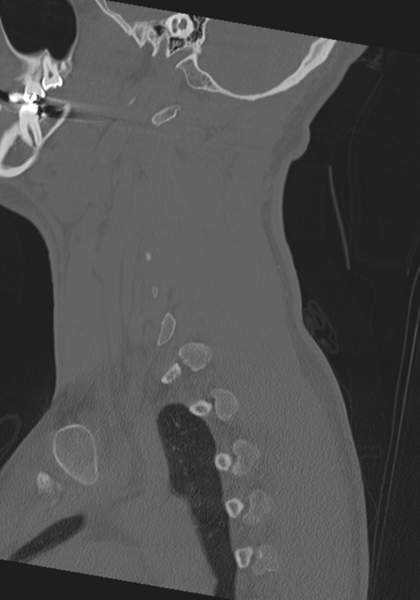 File:Cervical intercalary bone (Radiopaedia 35211-36748 Sagittal bone window 19).png