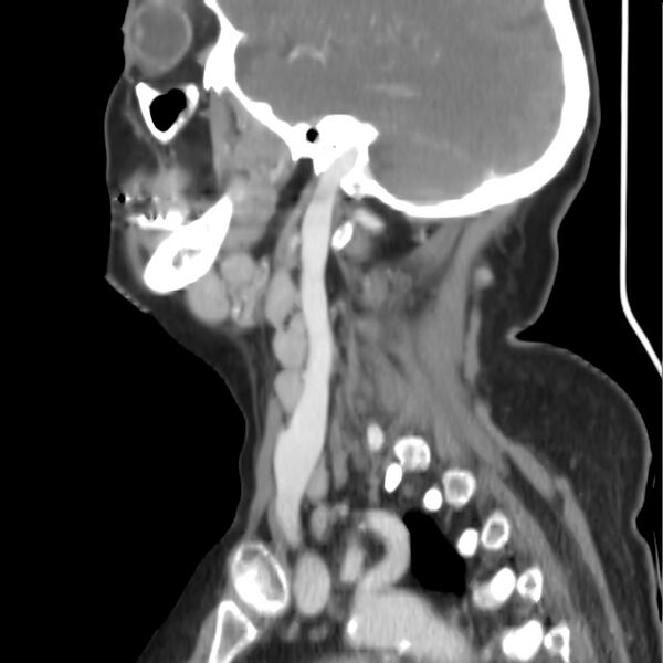 File:Cervical lymphadenopathy- cause unknown (Radiopaedia 22420-22457 D 28).jpg