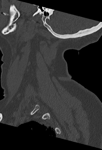File:Cervical spine ACDF loosening (Radiopaedia 48998-54070 Sagittal bone window 18).png