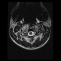 Cervical vertebrae metastasis (Radiopaedia 78814-91667 Axial T2 24).png