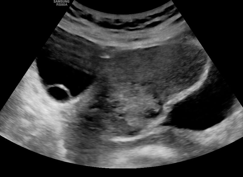 File:Cesarean scar ectopic pregnancy (Radiopaedia 77286-89726 Longitudinal 1).jpg