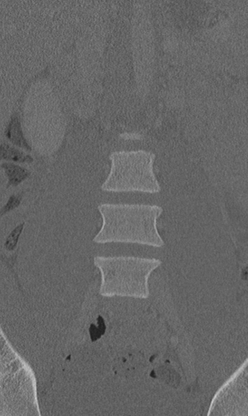 File:Chance fracture (Radiopaedia 40360-42912 Coronal bone window 17).png