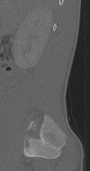 File:Chance fracture (Radiopaedia 40360-42912 Sagittal bone window 86).png