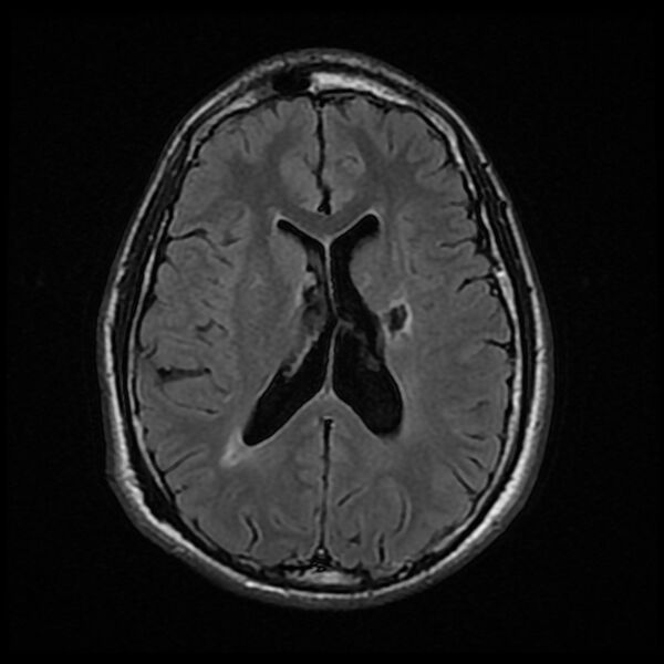File:Chiasmatic-hypothalamic juvenile pilocytic astrocytoma (Radiopaedia 78533-91235 Axial FLAIR 17).jpg
