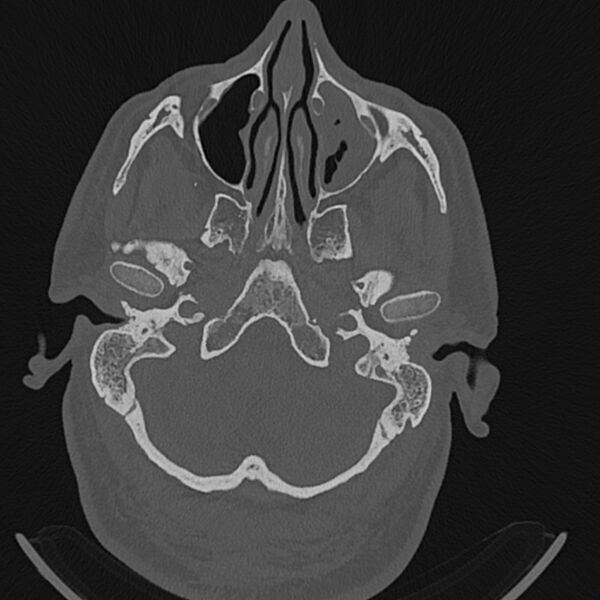 File:Cholesteatoma (Radiopaedia 68176-77673 Axial bone window 11).jpg
